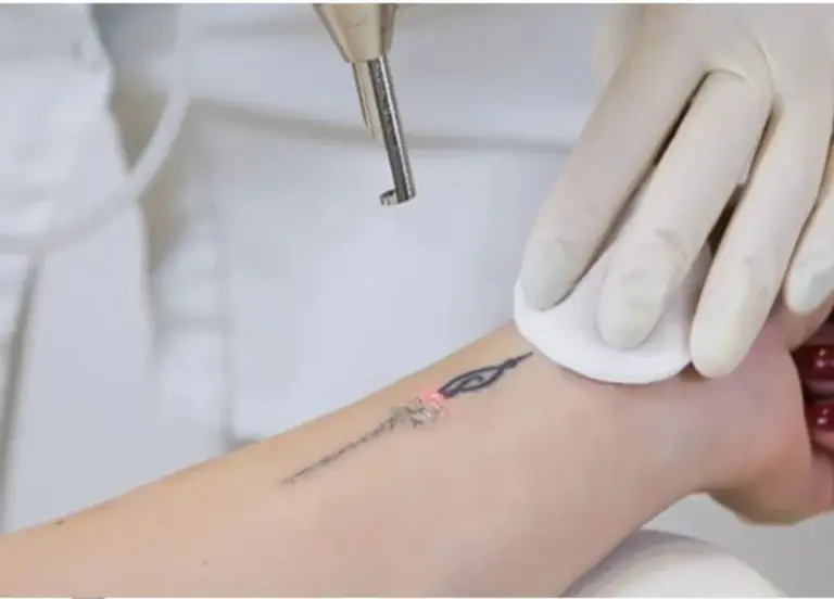 Remoção de Tatuagens